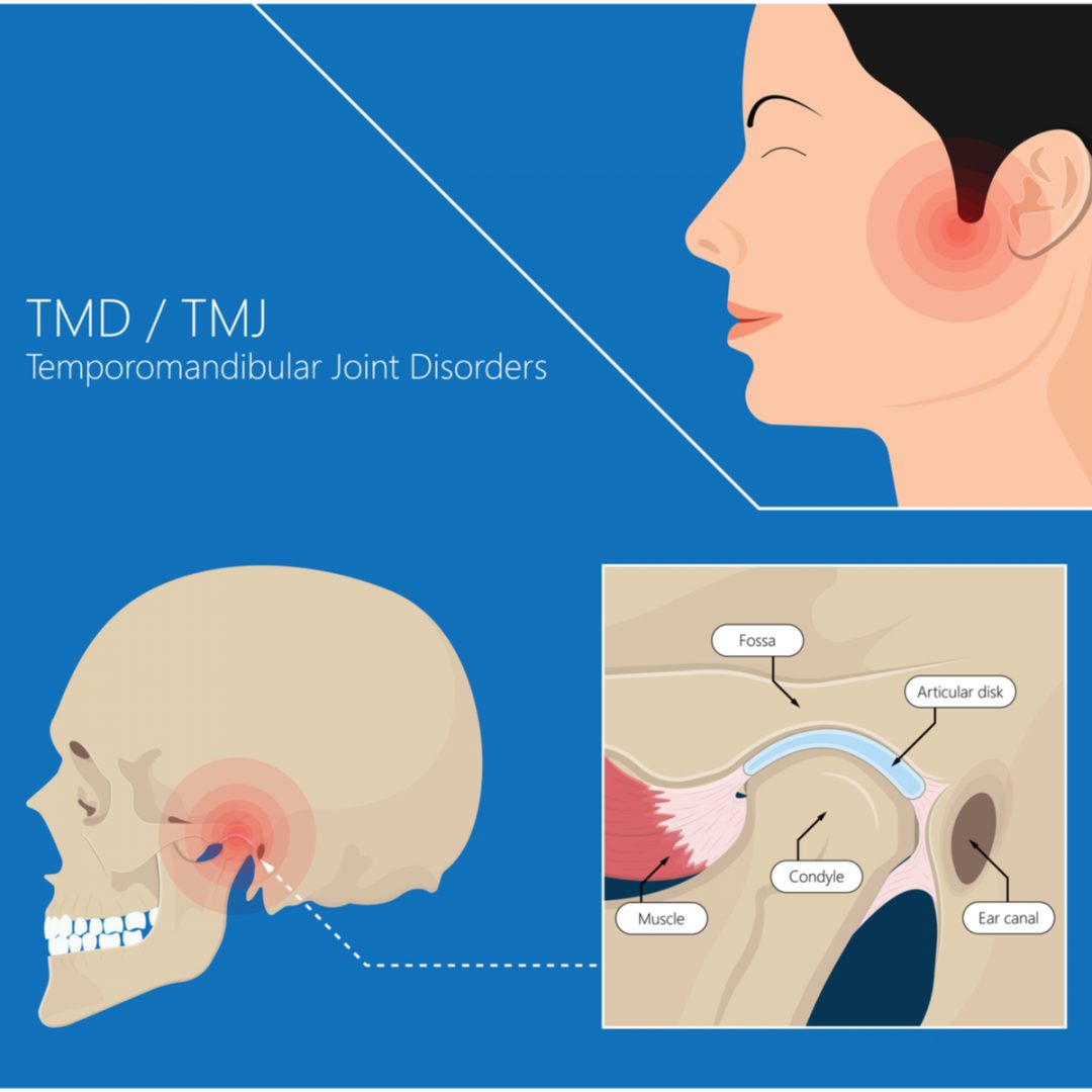 Tmj Disorderstmd Anderson Smith Therapy Institute 0294